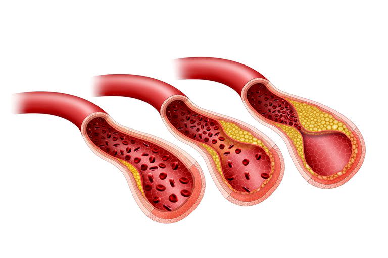 Según el estudio publicado en la revista Nature Cardiovascular Research, las mutaciones en las células del gen p53 son un factor de riesgo en el desarrollo de la enfermedad cardiovascular aterosclerótica, en la que hay una acumulación de grasas, colesterol y otras sustancias en las paredes de las arterias