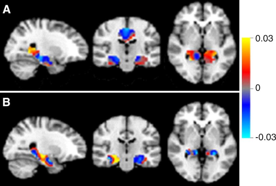 Discrimination maps for classifying mild cognitive impairment (MCI) subgroups, inside the masks that resulted in the highest accuracies. A: between patients with MCI that converted to Alzheimer's disease (MCIc) and s