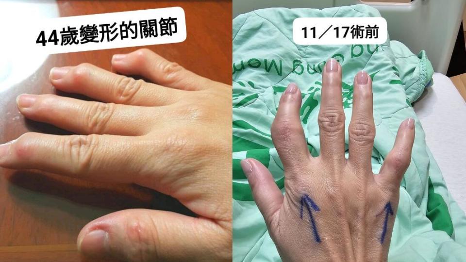 王瑞伶透露自己在44歲發病，手指關節開始發炎。（圖／翻攝自王瑞玲醫藥美食記者臉書）