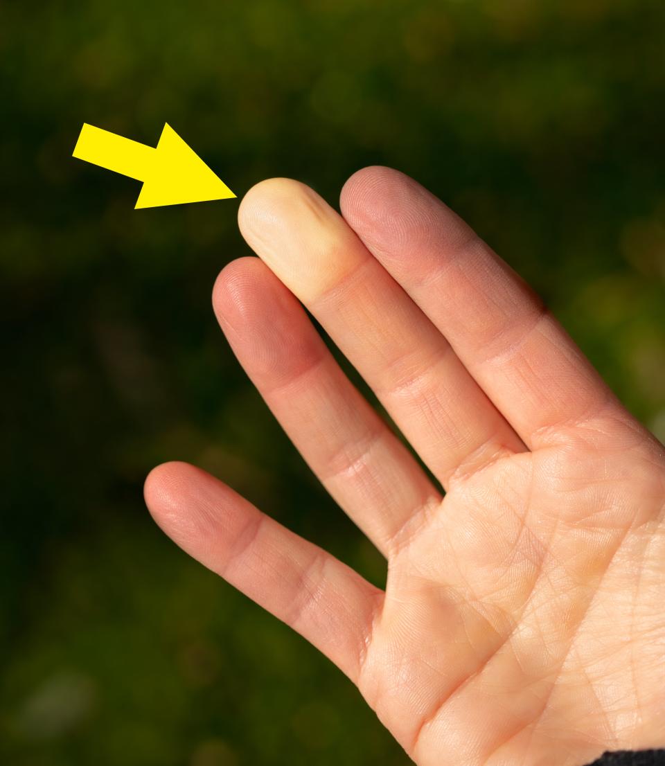 A close-up of a hand with fingers showing Raynaud's phenomenon, where one finger is pale yellow indicating restricted blood flow