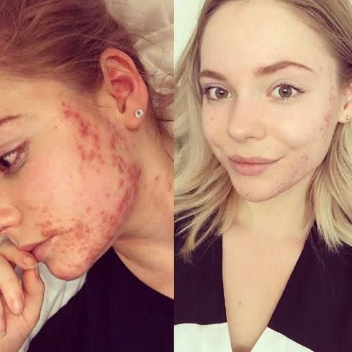 These pics were taken seven weeks apart, reveals Rachel. Photo: Instagram