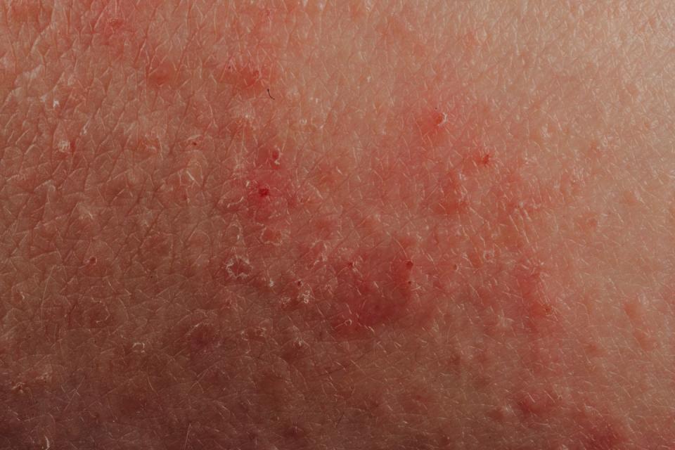 dermatitis eczema texture of ill human skin