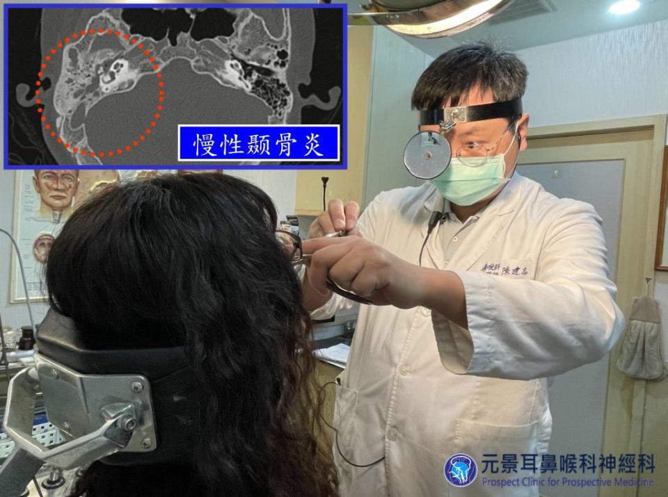 圖左上電腦斷層檢查顯示右側顳骨氣房及中耳腔內（紅圈所示），黏膜大量增生，充滿了液體。 （醫師陳建志提供）