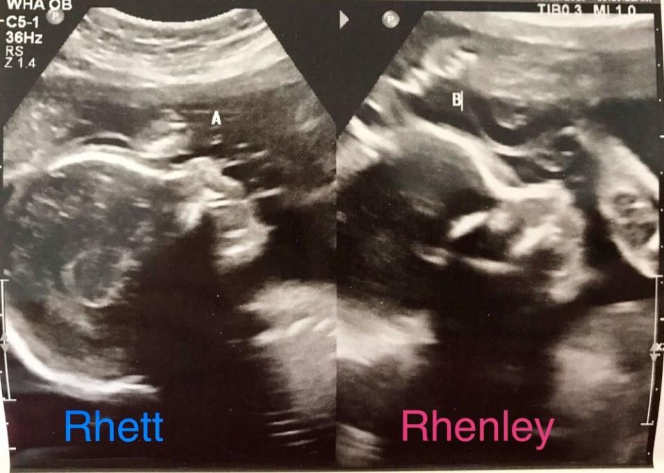 Whitney Bliesner's twins' ultrasound