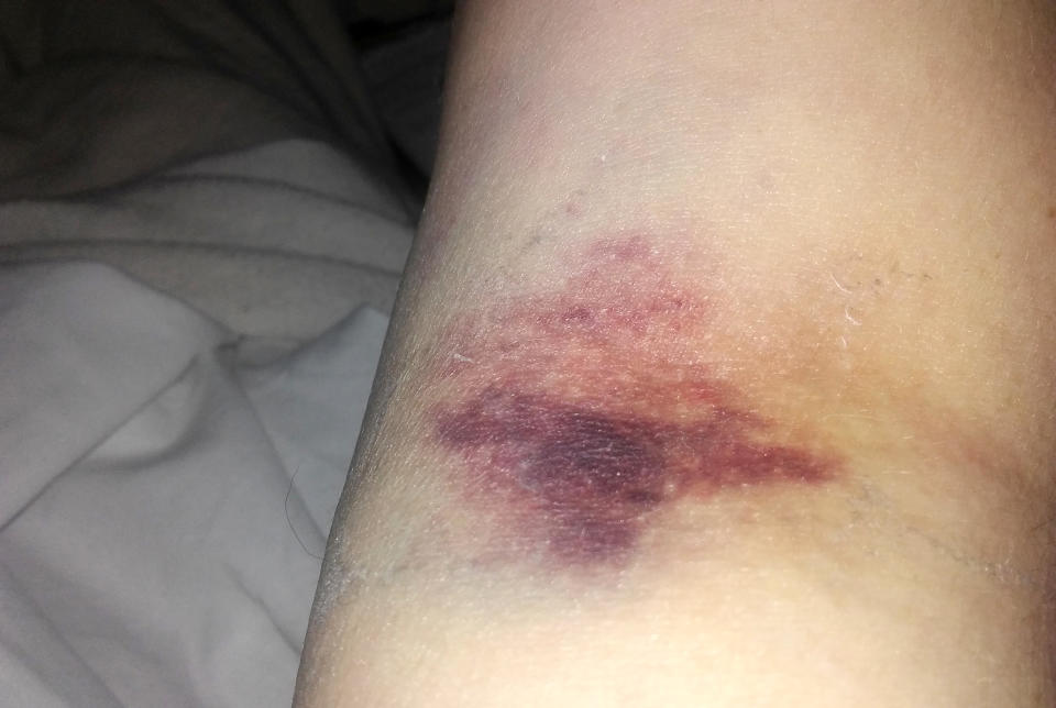 Pictured is Ms Middour's bruised arm after she contracted sepsis. Source: Caters