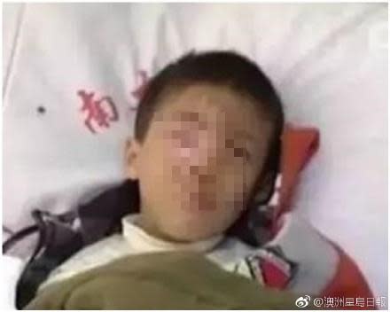 中國8歲童把「這物」丟寶特瓶　下秒突爆炸「右眼球溶解」終生失明！
