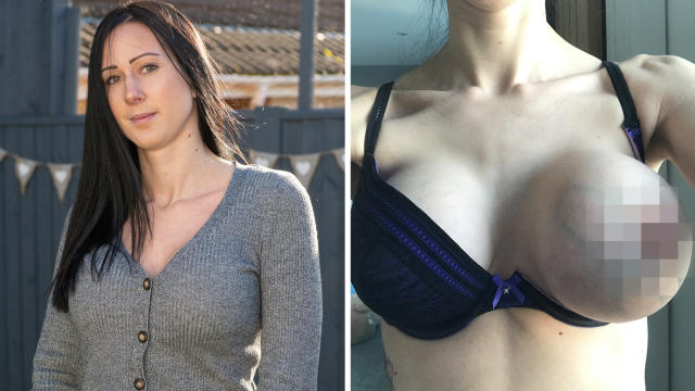 Mum BURST her own breast implants with enormous needle used for