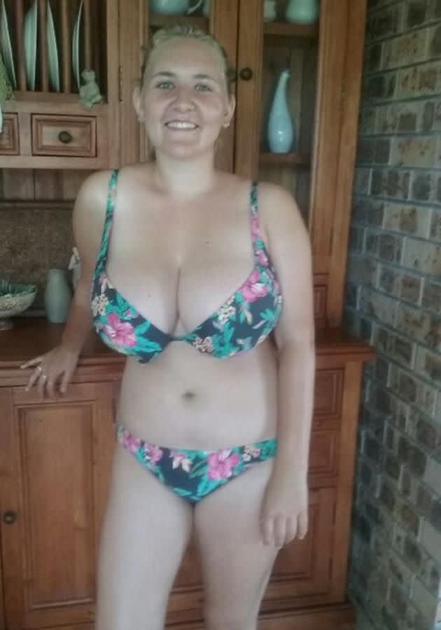 Woman crowdfunds 10GG breast reduction