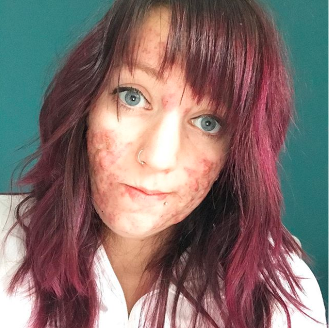 Klassen developed severe cystic acne when she was 25-years-old and pregnant. However, she developed sepsis and tragically lost the baby. (Photo: Instagram/stephmkt1d)