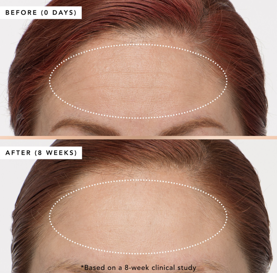 close up picture of woman's forehead showing difference in wrinkles, That Overnight Hustle AHA + BHA Resurfacer (Photo via Sephora)