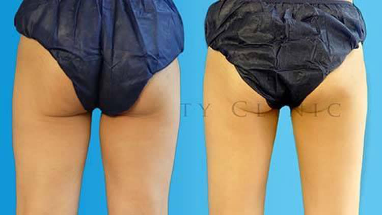 ▲改善大腿內側贅肉，臀腿凹凸有致，迎接完美大腿曲線！