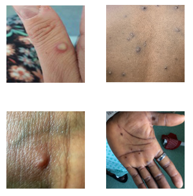 These images show examples of monkeypox rashes.