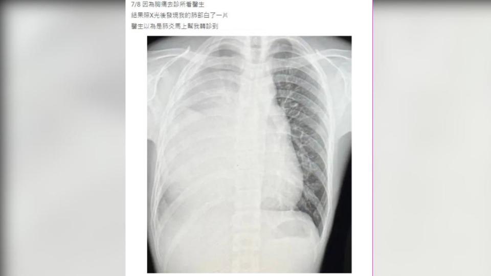 網友公開X光，肺部明顯白了一片。（圖／翻攝自Dcard）