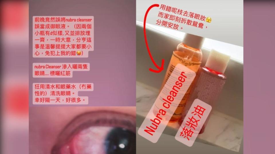 鄭秀文誤拿Nubra清潔劑來卸妝，導致雙眼不適冒血絲。（圖／翻攝自鄭秀文IG）