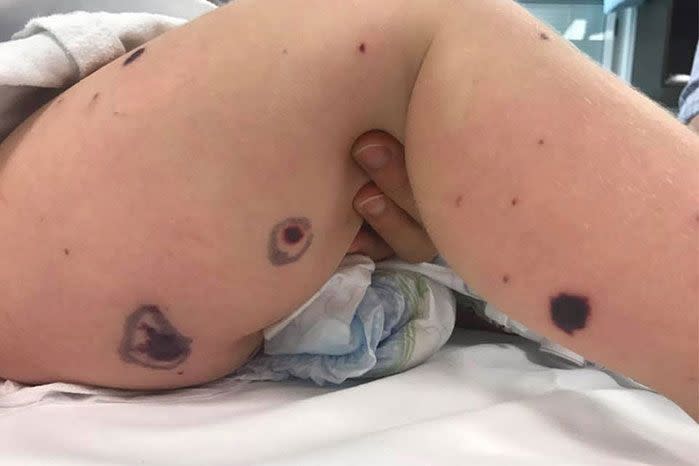 The toddler's legs are covered with black spots. Photo: 7news Brisbane