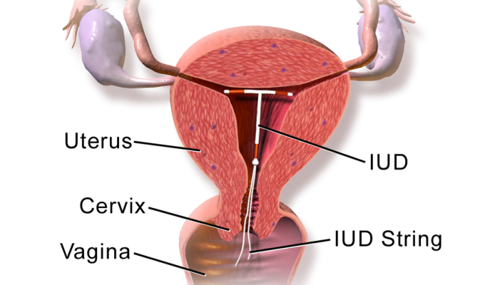 Iud Insert Porn - How Do IUDs Work? What You Need to Know About the Popular Form of Birth  Control