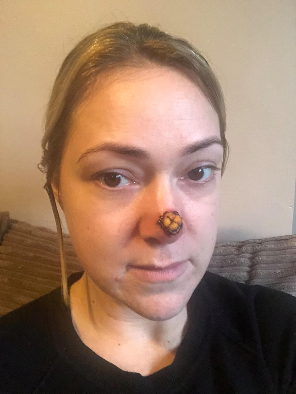 The mum was told if she didn't receive treatment she would have lost her nose within 10 years [Photo: SWNS]