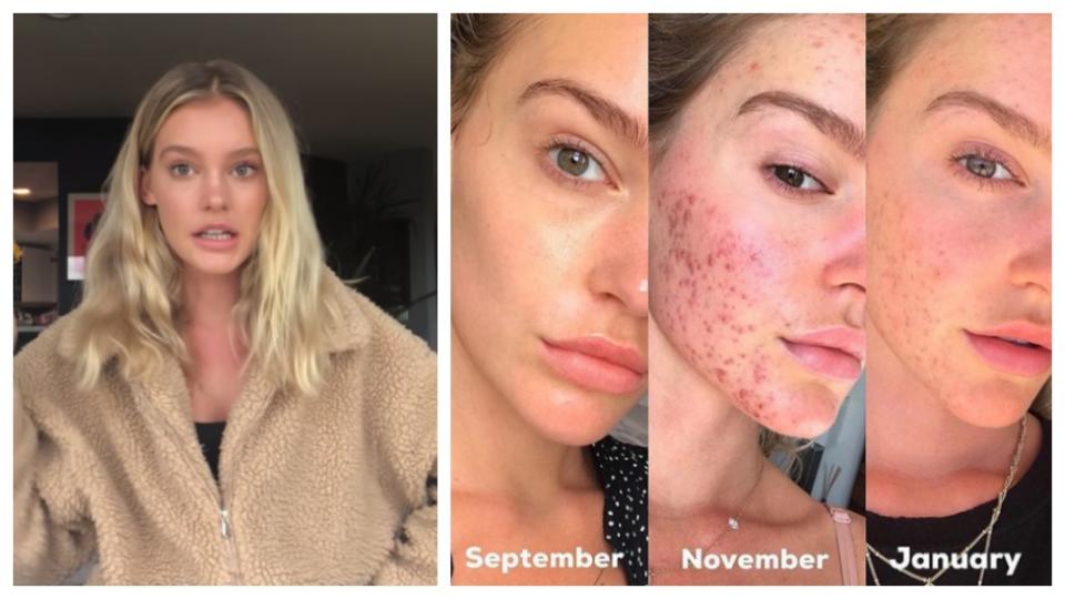 Model Georgia Gibbs has opened up about her skin transformation journey. Photo: Georgia Gibbs/YouTube/Instagram