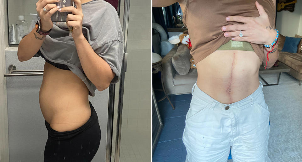 Bailey McBreen's bloated stomach with the tumour and scar running down her belly after surgery. 