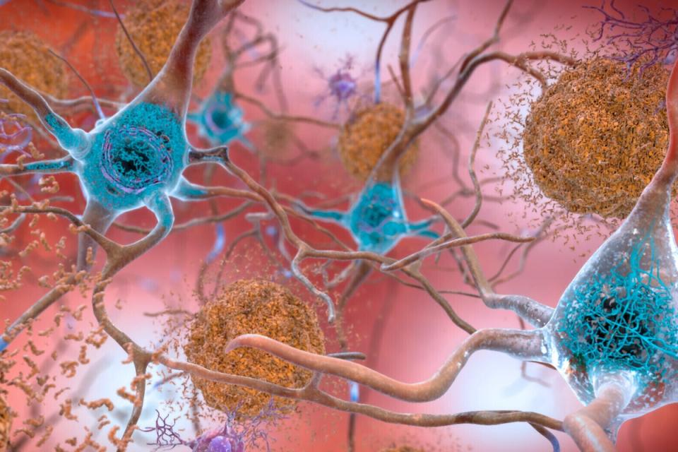 Cells in an Alzheimer’s-affected brain. (National Institute on Aging, NIH via AP)