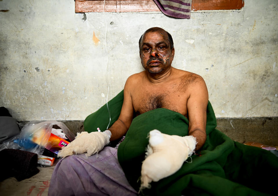 A survivor of a ferry fire receives treatment at a government medical hospital, in Barishal, Bangladesh, Friday, Dec. 24, 2021. Bangladesh fire services say at least 37 passengers have been killed and many others injured in a massive fire that swept through a ferry on the southern Sugandha River. The blaze broke out around 3 a.m. Friday on the ferry packed with 800 passengers. (AP Photo/Niamul Rifat)