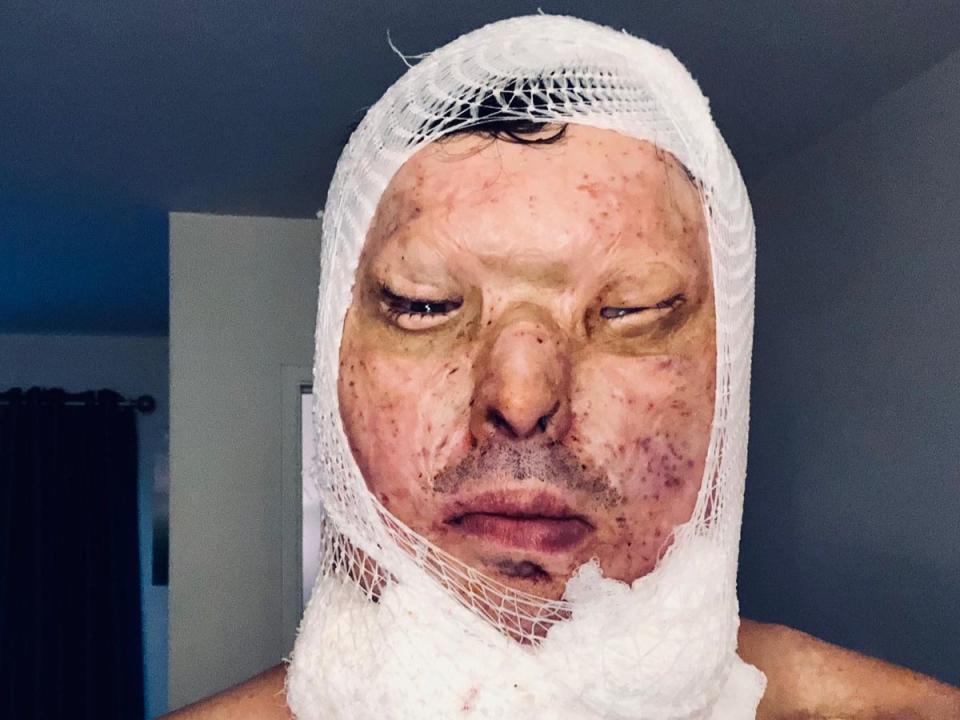 Mr Christopheros recovering from surgery – he has had to endure more than 60 procedures after he was doused in acid in 2014 (Andreas Christopheros)