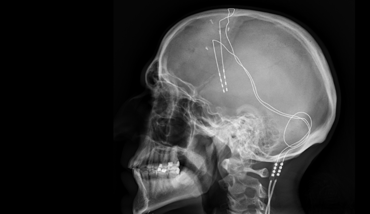 In deep brain stimulation, electrodes – the pale white lines – are implanted into a patient's brain and connected to a battery in a person's chest. <a href="https://commons.wikimedia.org/wiki/File:X-ray_of_deep_brain_stimulation_in_OCD,_L.png#/media/File:X-ray_of_deep_brain_stimulation_in_OCD,_L.png" rel="nofollow noopener" target="_blank" data-ylk="slk:Jmarchn/Wikimedia Commons;elm:context_link;itc:0;sec:content-canvas" class="link ">Jmarchn/Wikimedia Commons</a>, <a href="http://creativecommons.org/licenses/by-sa/4.0/" rel="nofollow noopener" target="_blank" data-ylk="slk:CC BY-SA;elm:context_link;itc:0;sec:content-canvas" class="link ">CC BY-SA</a>