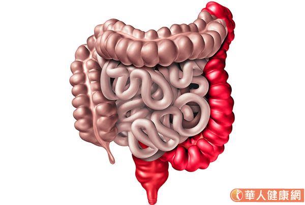 潰瘍性結腸炎常見症狀為帶有血便的腹瀉，嚴重會出現腹痛、體重下降的情形，若大腸直徑因發炎腫脹超過6公分以上，甚至會併發毒性巨結腸症，若不進行手術，恐惡化成腸穿孔或破裂，形成腹膜炎引發敗血症而危及生命。