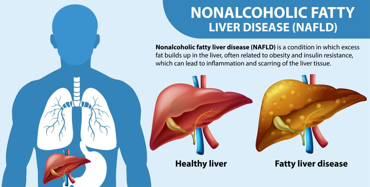 NAFLD