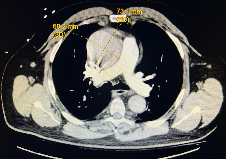 A CT scan of Steven Rosenberg's chest revealed Type A aortic dissection. The ascending aorta on the right rises above the heart on the left. The aorta is enlarged to 6 centimeters, bigger than a can of soda. A normal aorta is the size of a garden hose.