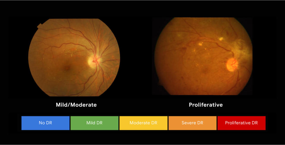 Diabetic retinopathy can be identified via computer vision technology.
