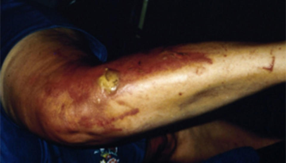 Blisters caused by the giant hogweed. Source: US Department of Agriculture