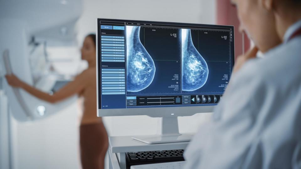 PHOTO: A woman undergoing a mammography screening procedure and a screen showing the mammogram scans of dense breast tissues. (STOCK PHOTO/Adobe Stock)