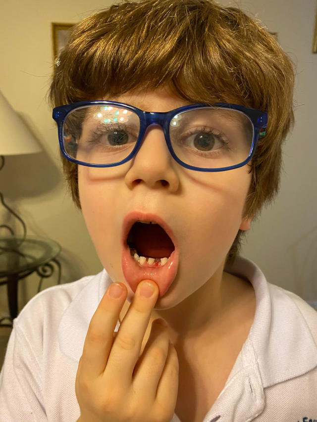 Julia Meyerhoff Cox's son, Vincent, calls his stainless steel-capped tooth his 