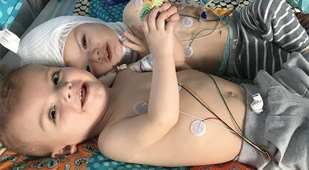 Jadon and Anias McDonald were born conjoined at the crown. Photo: Facebook/Nicole McDonald