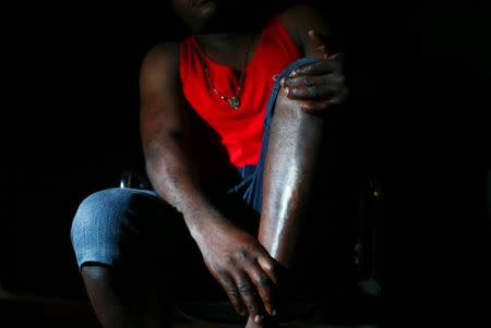 Nigerian Charles Otokiti, 37, who was rescued at sea after passing through Libya in 2016, shows his scars on his leg as he is pictured in Rome, Italy, July 3, 2018. Picture taken July 3, 2018. REUTERS/Alessandro Bianchi