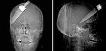 In this undated Metropolitan Police handout, x-ray images show how a teenage boy cheated death when a five inch knife was plunged into his head. The 16-year-old and two other young men were injured when they tried to stop a friend being robbed at a bus stop. He was rushed to hospital with the kitchen knife still stuck in his forehead after the attack in Walworth, south London, last November. (AP Photo/ Metropolitan Police, HO)