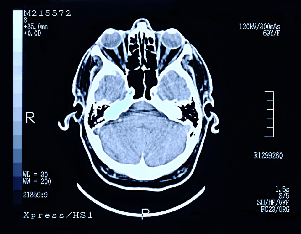 A brain scan