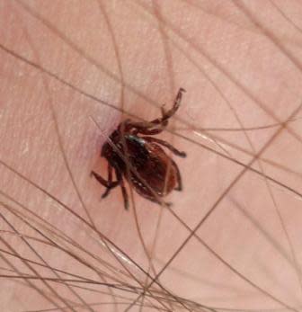 Embedded Deer Tick: Courtesy of Socal Trail Riders