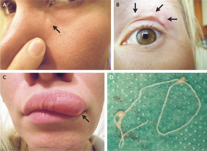 Doctors quickly identified the lump as a long, parasitic roundworm called Dirofilaria. Source: New England Journal of Medicine