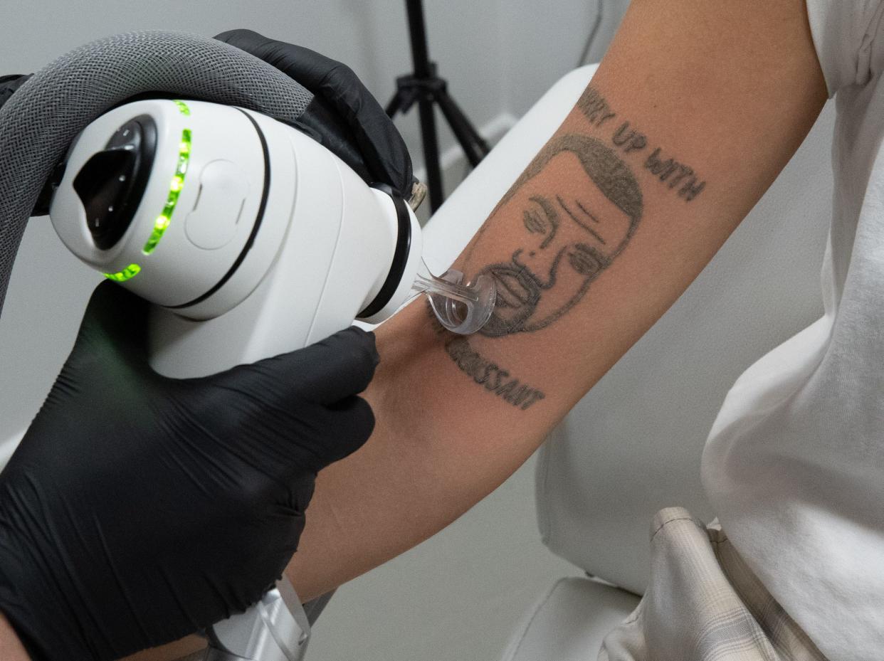 A woman is getting her Kanye West tattoo removed at Naama Studios.