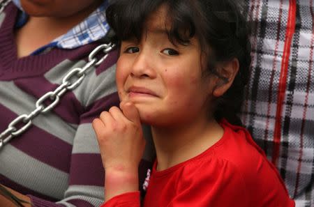 Arum Carhuancho, a resident child of the town Cerro de Pasco, displays her skin rash during a protest for rampant pollution from a sprawling polymetallic mine operated by Peruvian mining company Volcan, outside of the health ministry in Lima, Peru June 22, 2017. REUTERS/Mariana Bazo