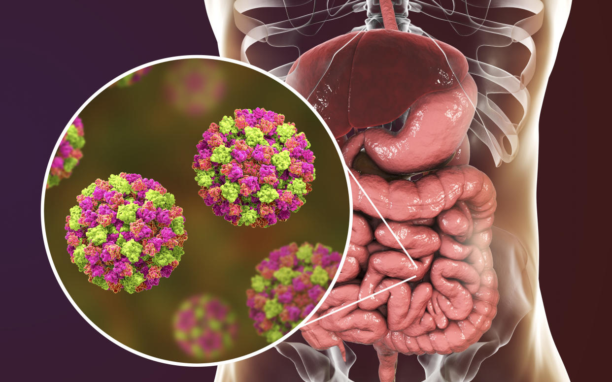 Norovirus infection, computer illustration. Norovirus is a genus of RNA (ribonucleic acid) viruses (of the family Caliciviridae), which cause about half of all gastroenteritis cases around the world. The disease is characterised by nausea, vomiting, diarrhoea and abdominal pain. The diarrhoea results in fluid loss and dehydration, which may become life-threatening in the young, the elderly, and the immunocompromised if not treated promptly.