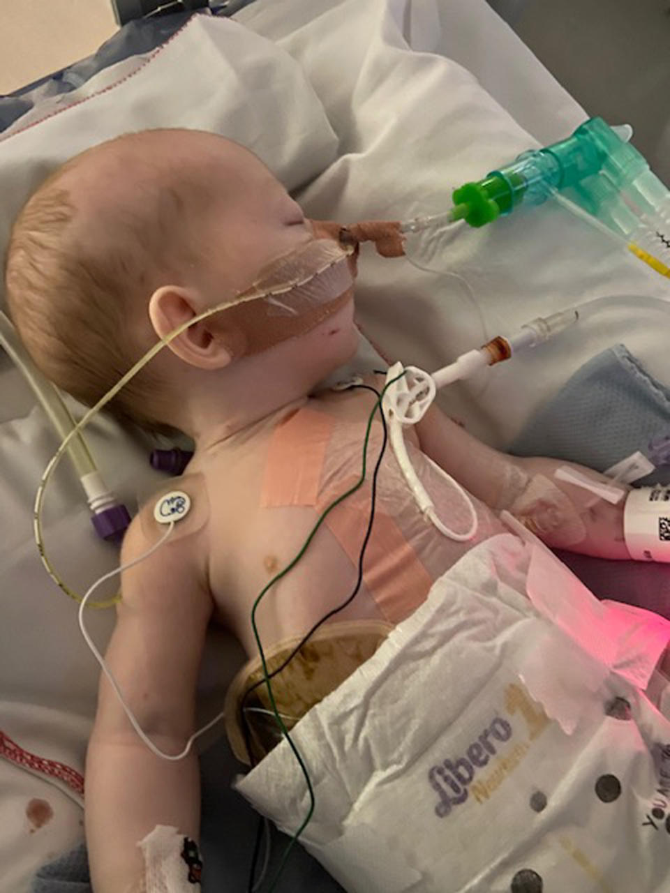 Baby Elliot was born with his internal organs outside his body. (PA Real Life/Collect) 