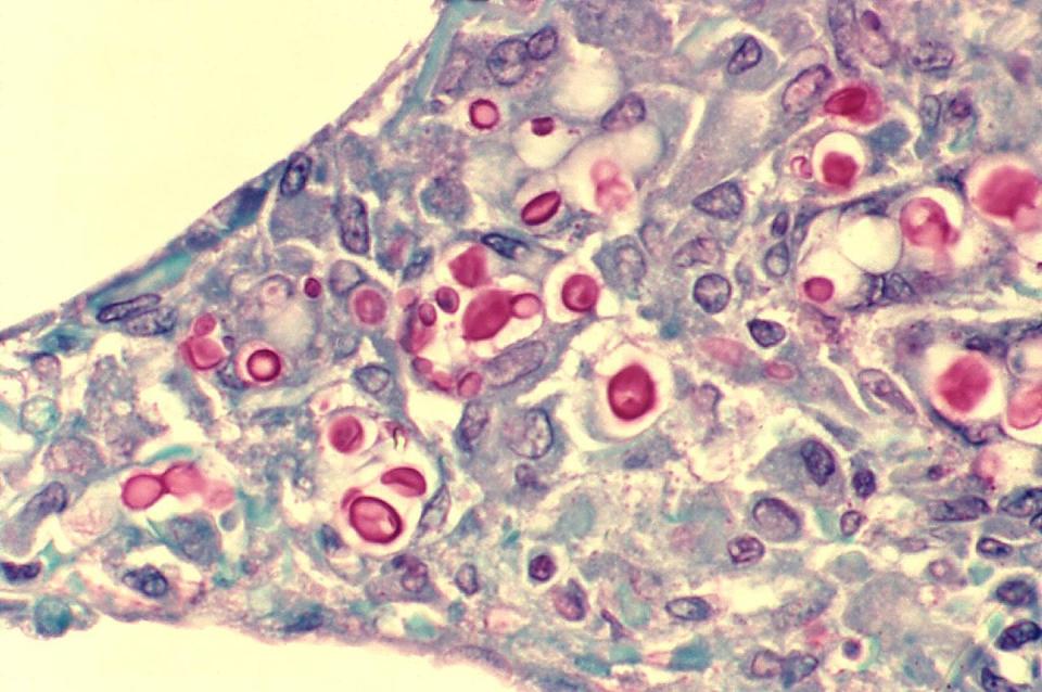 Criptococosis de pulmón en paciente con sida. La histopatología del pulmón muestra un tabique alveolar ensanchado que contiene algunas células inflamatorias y numerosas levaduras <em>Cryptococcus neoformans</em>, uno de los patógenos incluidos en el informe de la OMS. La capa interna de la cápsula de levadura aparece teñida de rojo. CDC / Dr. Edwin P. Ewing, Jr.
