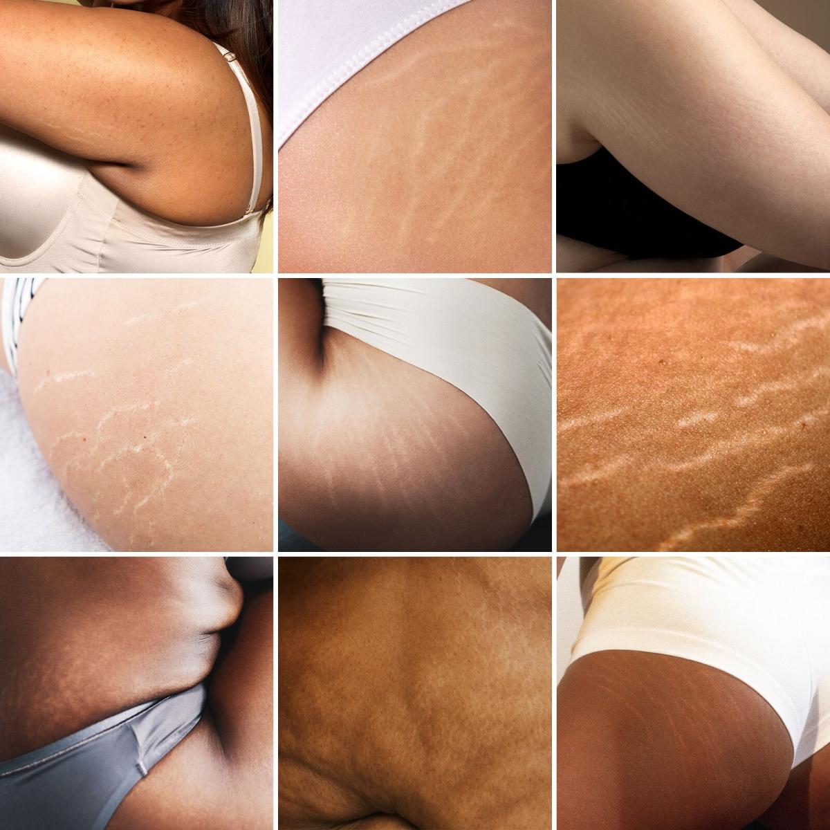 Stretch Marks Are Actually Completely Normal (And Incredibly