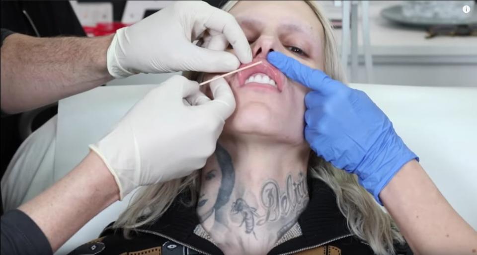 Jeffree Star Reveals a Doctor Secretly Injected His Lips With Silicone