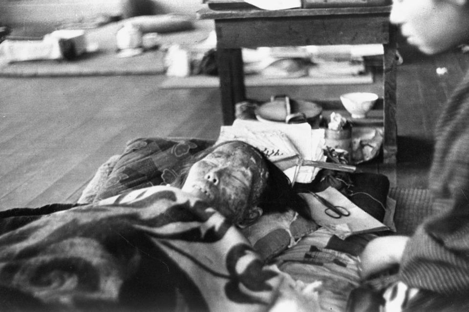 A female Nagasaki atomic bomb victim receives a treatment at Shin Kozen Elementary School in Aug. 1945 in Nagasaki, Japan. (Photo: Yasuo Tomishige/The Asahi Shimbun via Getty Images)