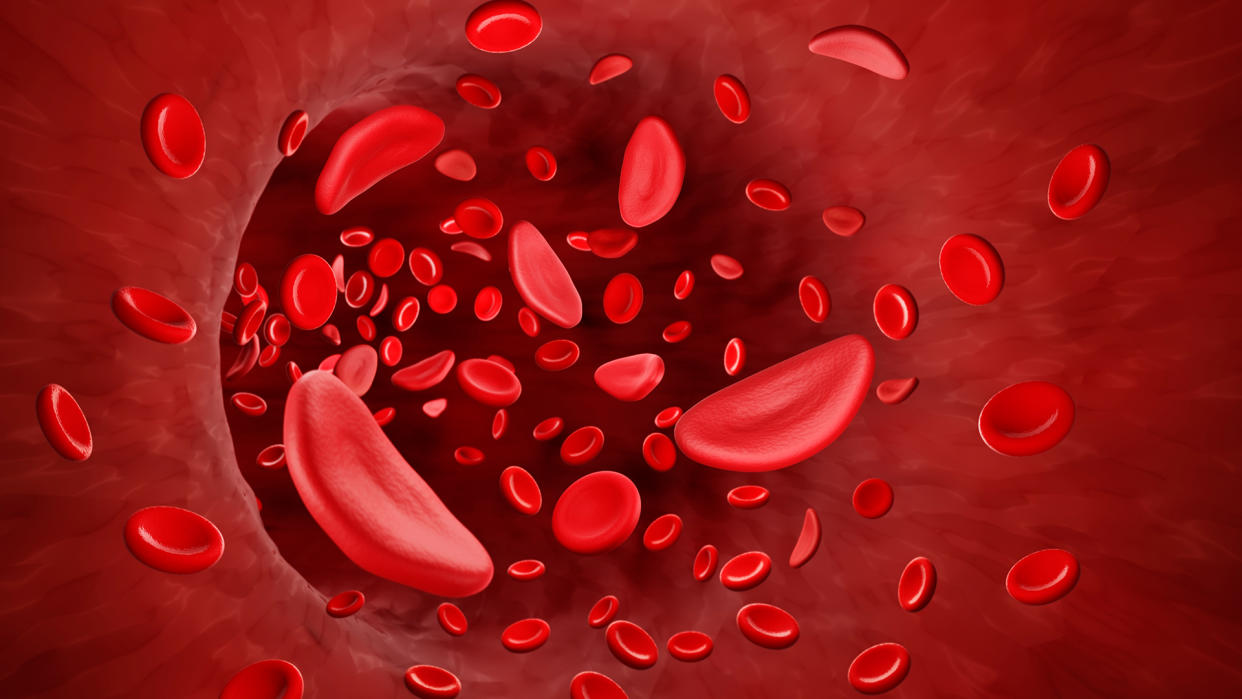  Illustration of healthy, round red blood cells and sickle shape blood cells flowing through a blood vessel. 