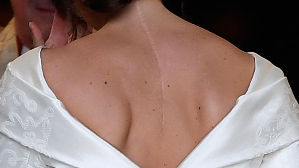 Princess Eugenie has a scar from back surgery